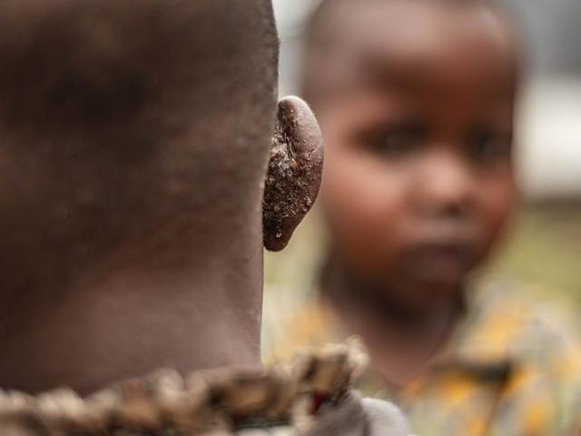 Ebola en RDC : une épidémie qui ressurgit à l&rsquo;est, aux portes de l&rsquo;Ouganda